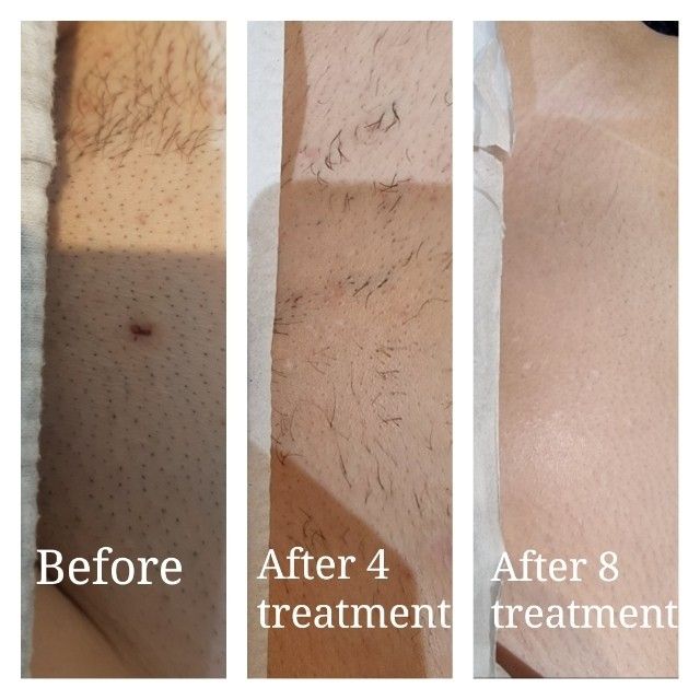 Laser Haarentfernung Intimbereich — Verlauf vorher, nach 4 und nach 8 Sitzungen