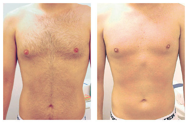 Laser Haarentfernung Brust und Bauch für Männer — Vorher-Nachher-Vergleich